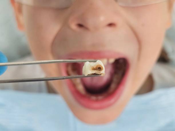 Best Emergency Dental Extractions in Owensville, MO